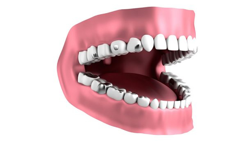 illustration of pink gums, white teeth with silver amalgam fillings