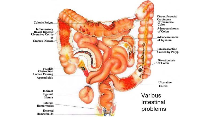 Various Intestinal Promlems on anatomy of small and large intestines
