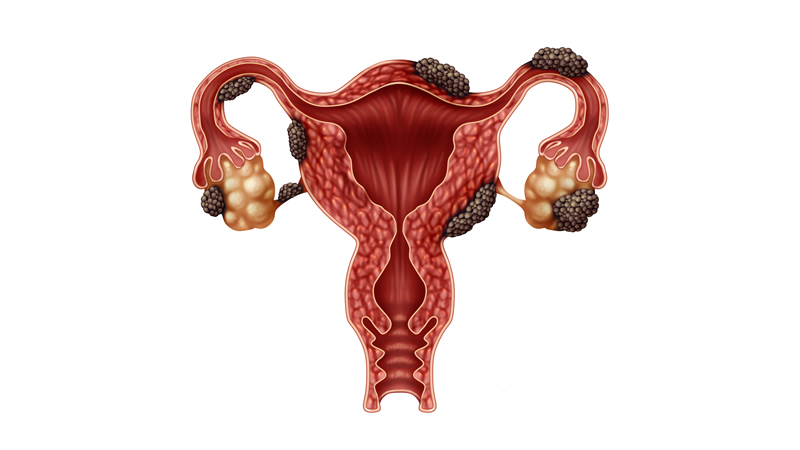 anatomy of womans reproductive organs with endometriosis on white