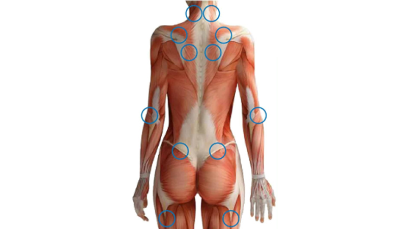 fibromyalgia points in blue circles on females back