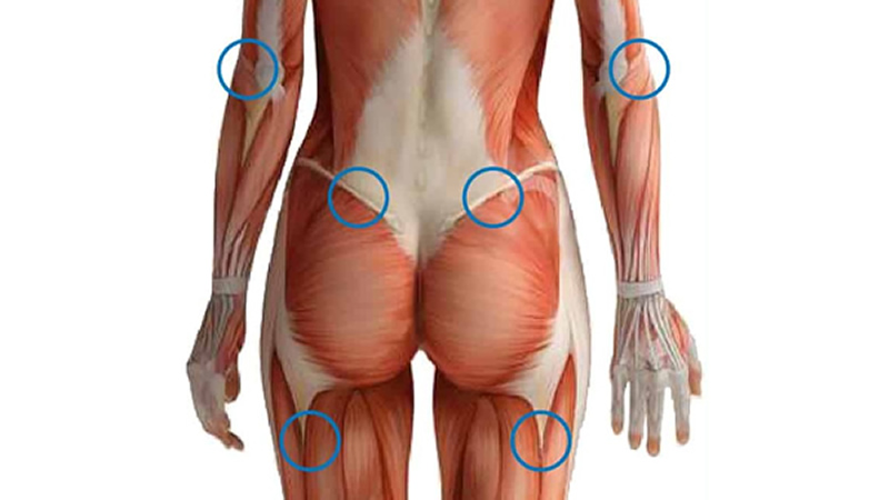 fibromyalgia points in blue circles on females lower back