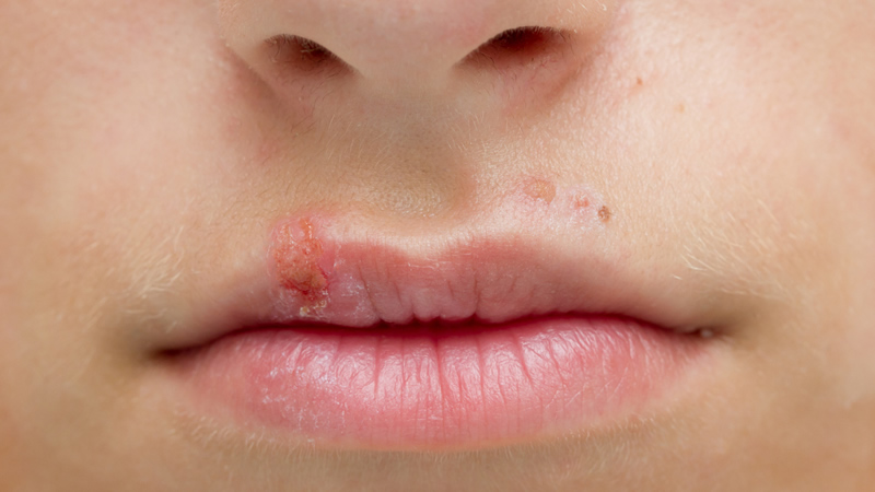 herpes, cold sores, lesion on lips