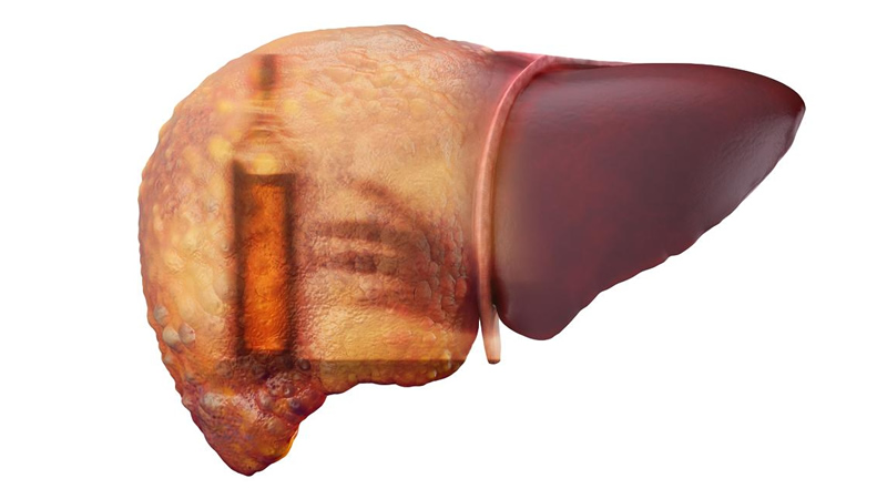 cirrohsis of the liver