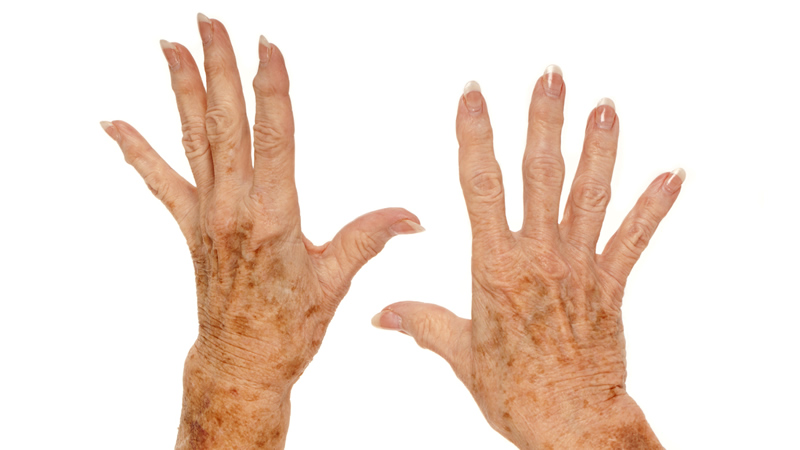 older womans hands with dark patches, liver spots, sun damage