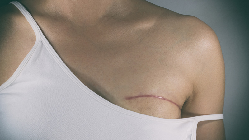 womans bare shoulder showing mastectomy scar