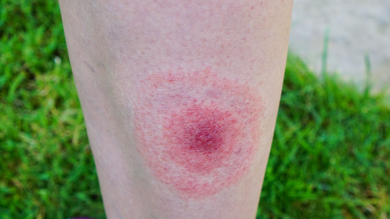 red round rash on skin, grass behind
