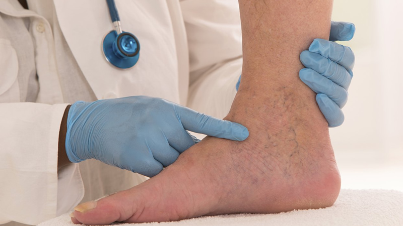 blue gloved hands pointing at ankle with spider veins
