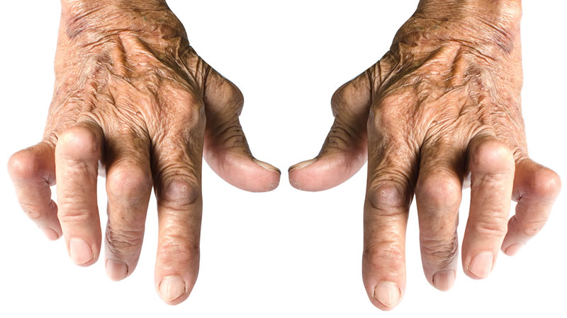 Painful Arthritic Hands