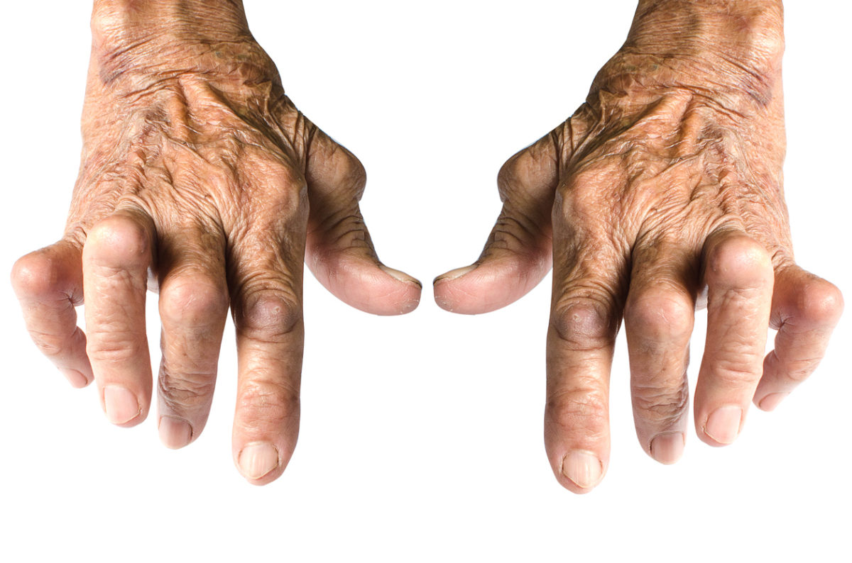 two hands affected by Rheumatoid Arthritis