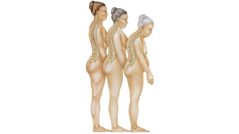anatomy of womans aging spine, curving forward